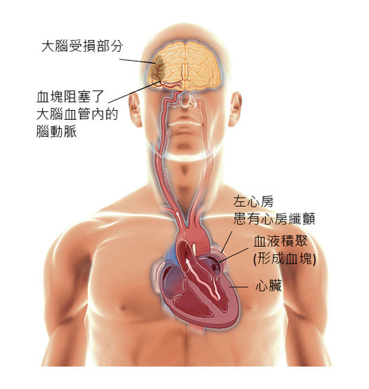 心房纖顫引起中風的機會較一般高[